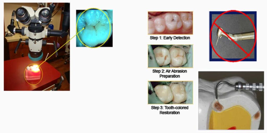 Needle Free Dentistry Alhambra Dental
